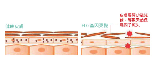 过敏性湿疹